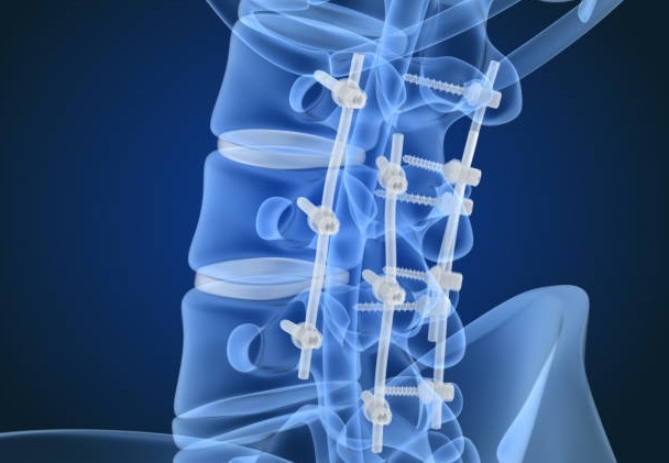 best spine fixation surgeon in goregaon